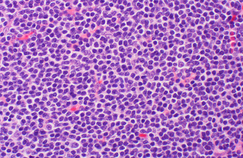 B-cell lymphoma with cells stained purple