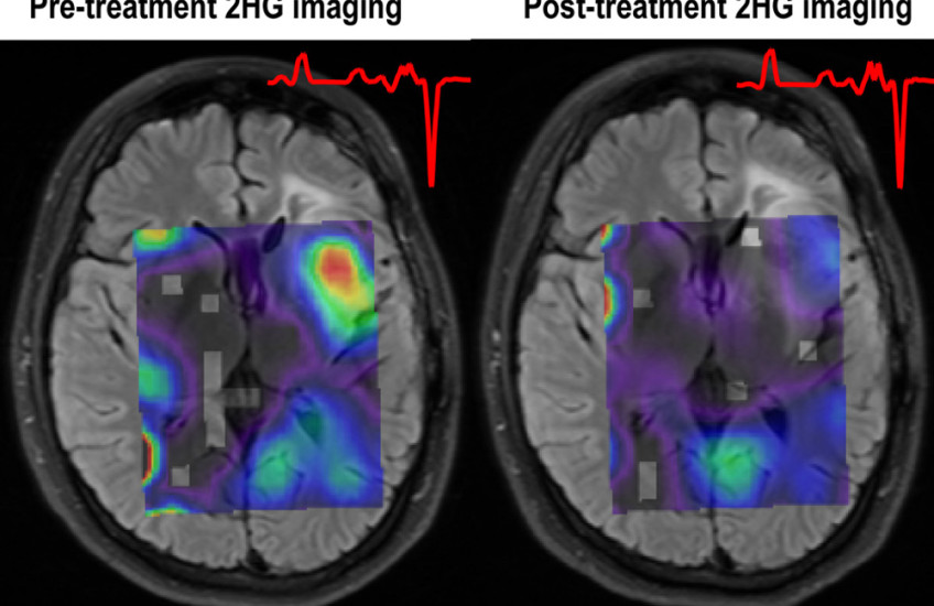 New View of Gliomas