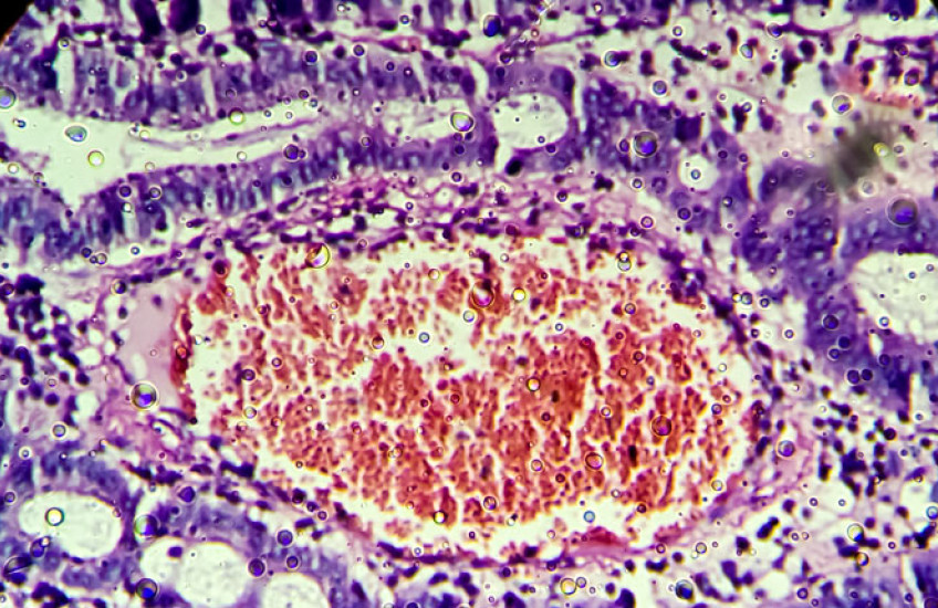 Microscopic image of colonic adenocarcinoma. Image: Md Ariful Islam/iStock/Getty Images Plus