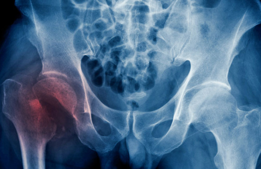 X-Ray image of a human hip with right join reddish colored 