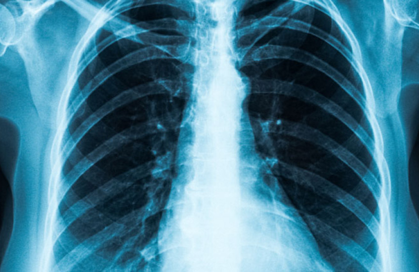 Image of a chest x-ray