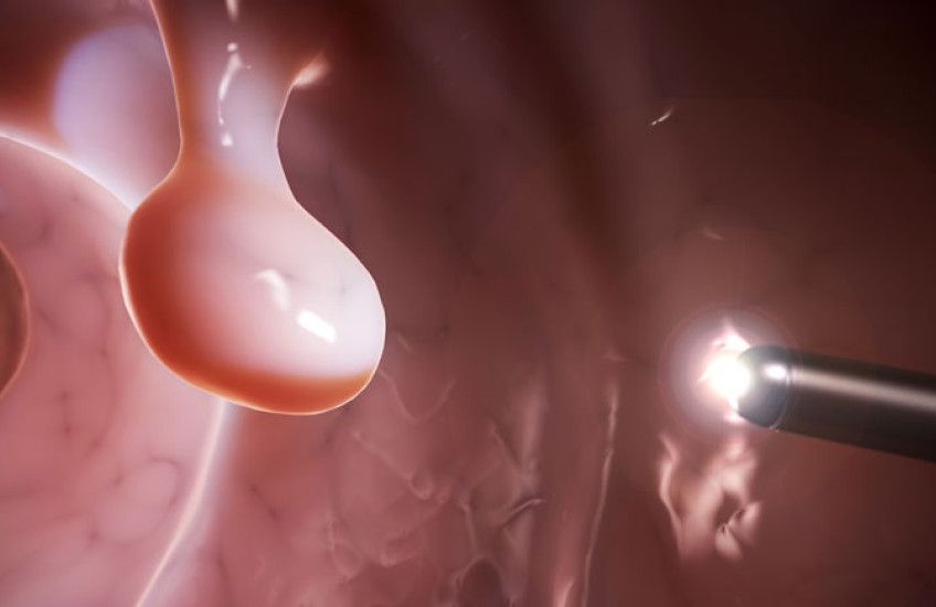 Illustration of a polyp inside of a colon with a laparoscopic light near it 