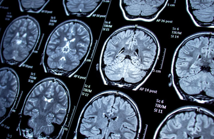 Photo of an MRI showing multiple images of a human brain