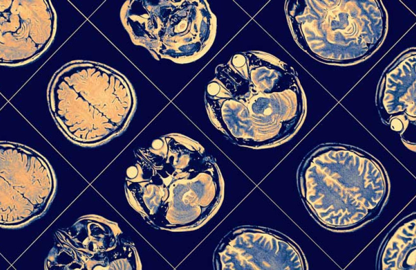 Image of brain scans