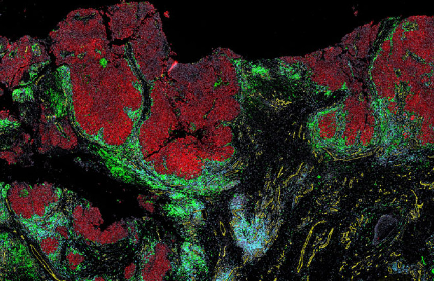 Patches of red melanoma cells surrounded by layers of blue and green immune cells. 