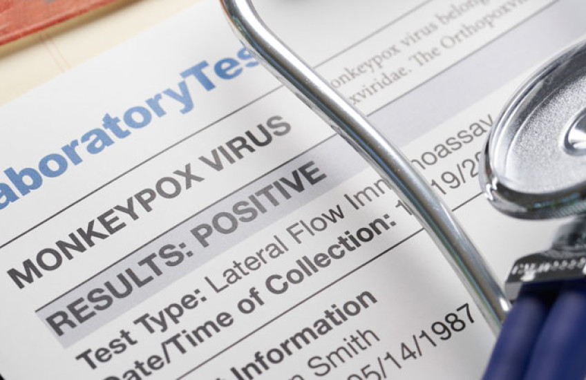 Shot of a positive monkeypox lab test report with a stethoscope