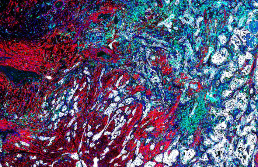 A close up image of a lung cancer tumor, composed of patches of red, white, blue, and green cells