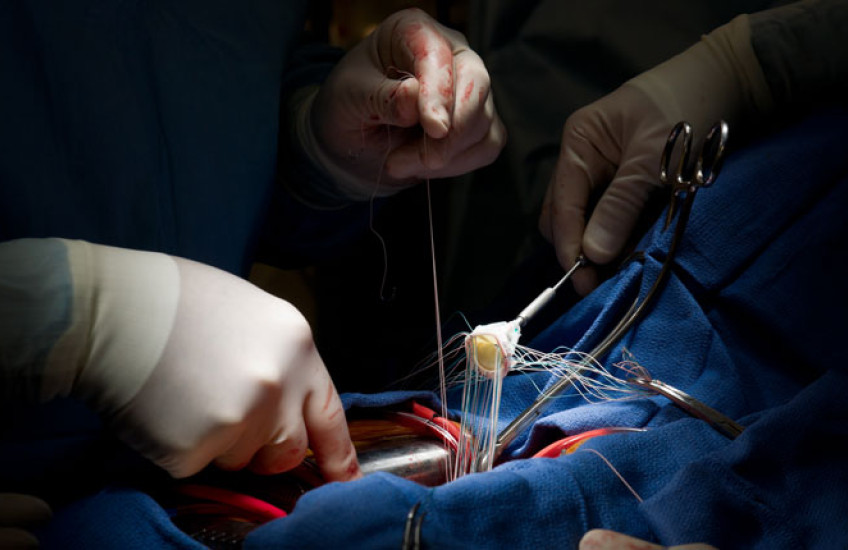 Photo of open heart surgery. 