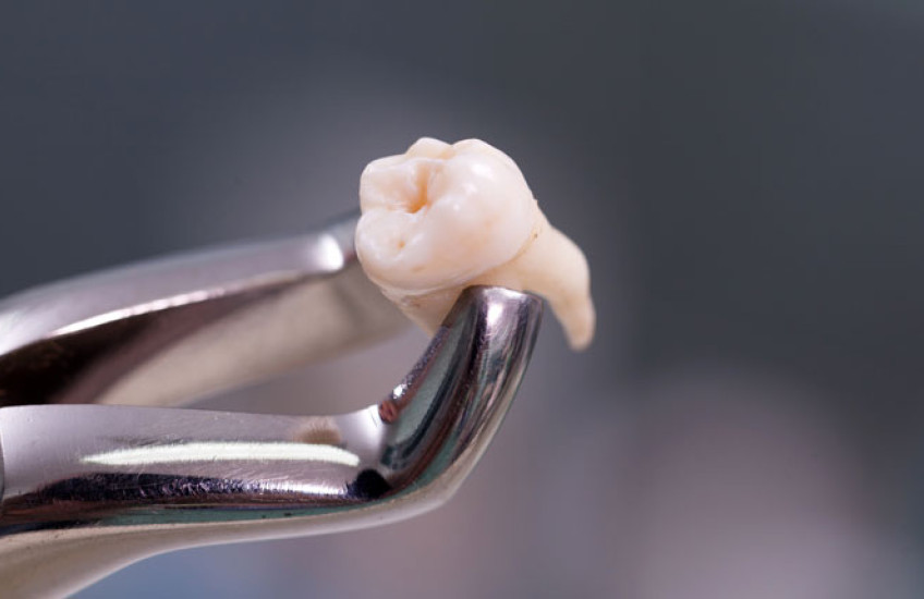 Photo of a dental tool holding an extracted tooth