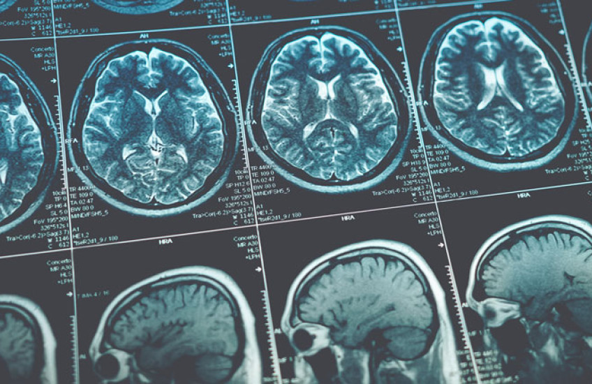 Rows of blue and white brain scans on a black background