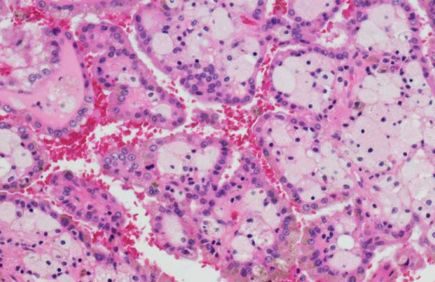 renal cancer cells