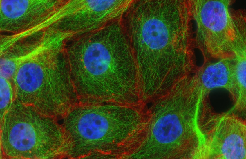 Stress fibers and microtubules in human breast cancer. Vivid blue clusters surrounded by green and red filaments