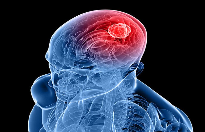 brain tumor