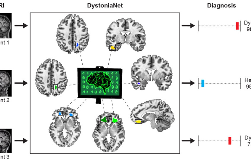 schematic showing diagnosis of dystonia in brains of three patients