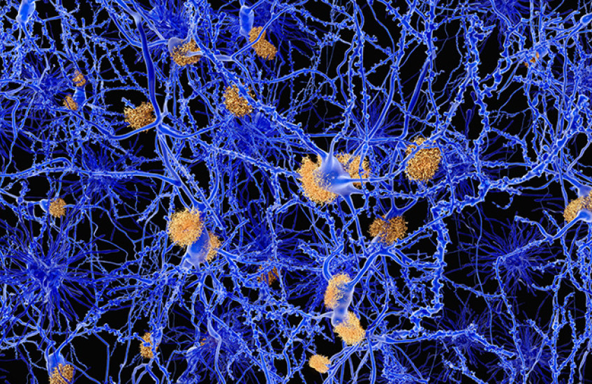 Alzheimer disease, neuron network with amyloid plaques