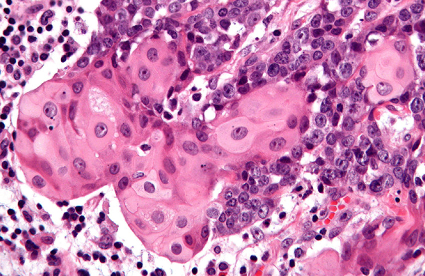 Purple and pink stains show abnormal cells