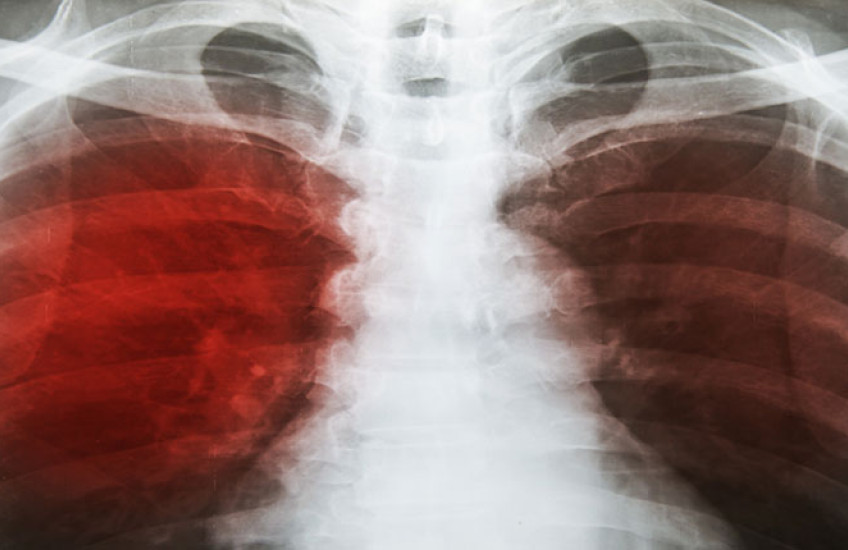X-ray of infected lungs
