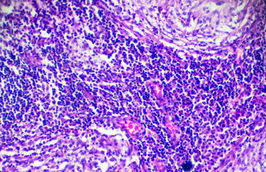 Tuberculosis pathological sample under microscope