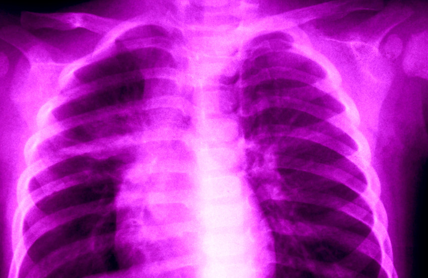 Colorized x-ray image of lungs.
