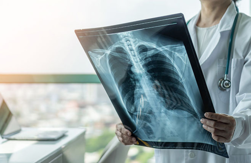 physician looking at an X-ray image of the lungs
