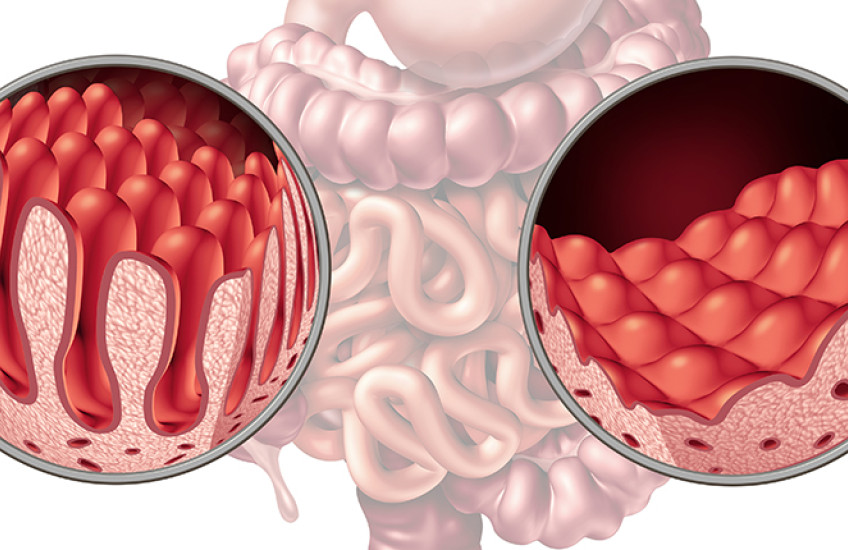 normal and damaged villi from celiac