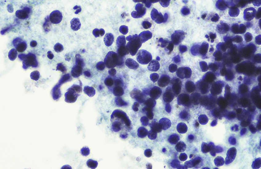 Cancer cells show as purple circles against blue tissue