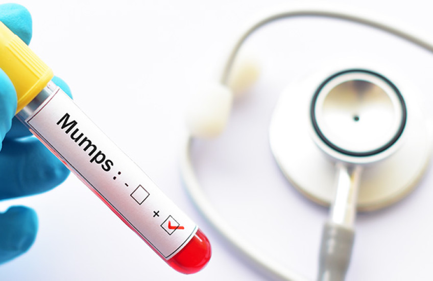 photo of gloved hand holding vile marked mumps