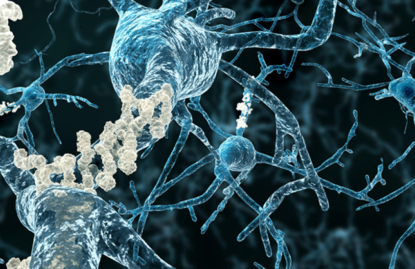 neurons with amyloid plaques