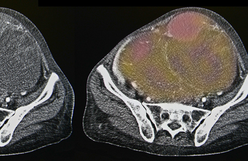 ovarian cancer image