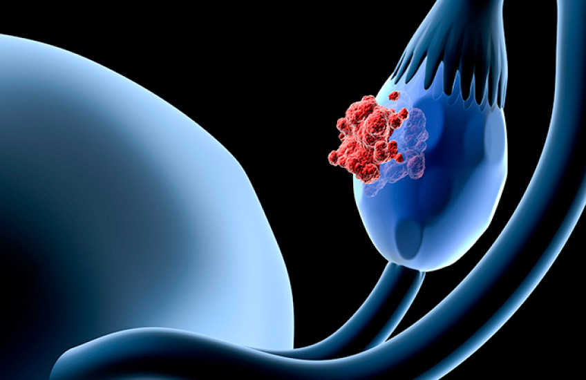 illustration of ovarian cancer