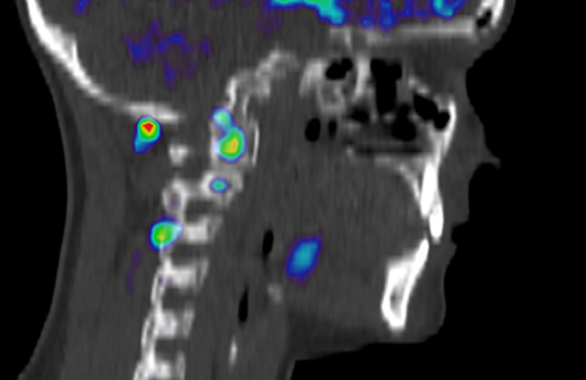 An image of a person’s head and neck showing normal tissue in black and white tones and inflammation in bright colors.