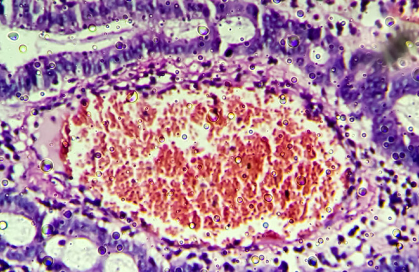 Microscopic image of colonic adenocarcinoma. Image: Md Ariful Islam/iStock/Getty Images Plus
