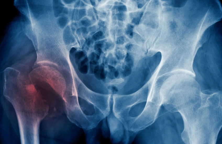 X-Ray image of a human hip with right join reddish colored 
