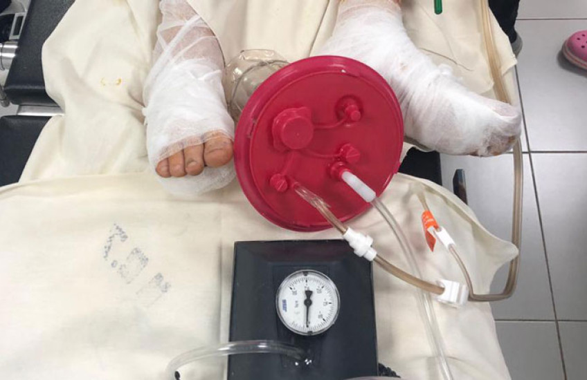 Image of a patient's bandaged feet and a wound therapy pump 