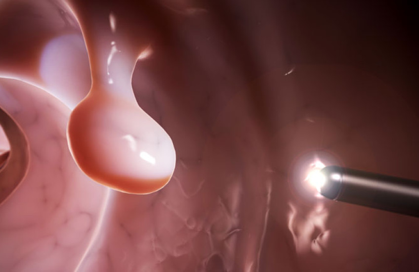 Illustration of a polyp inside of a colon with a laparoscopic light near it 