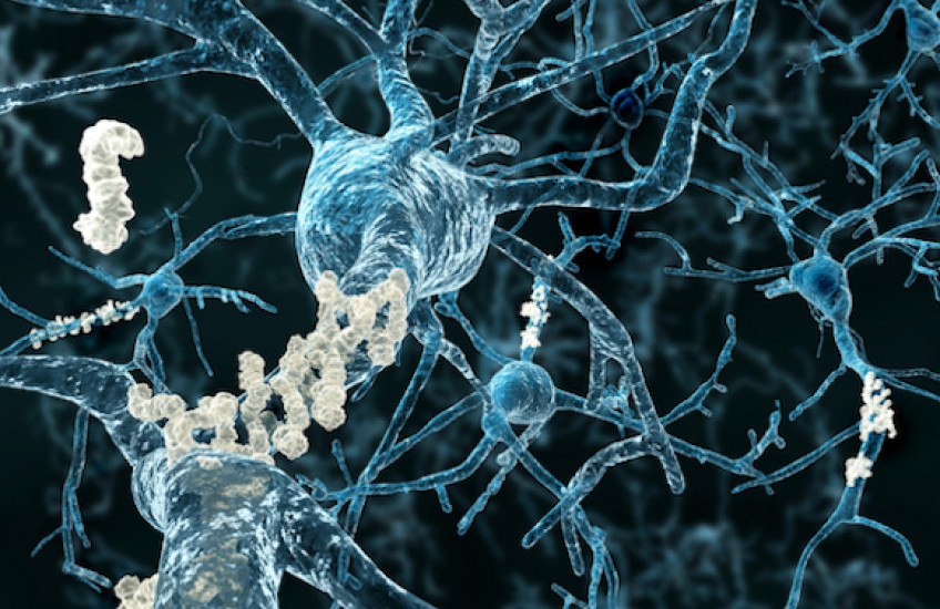 Neurons with amyloid plaques