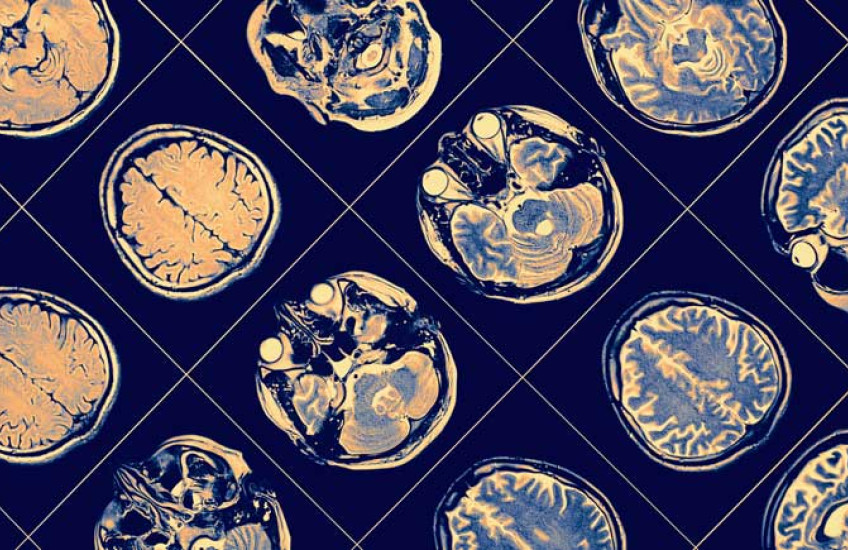Image of brain scans