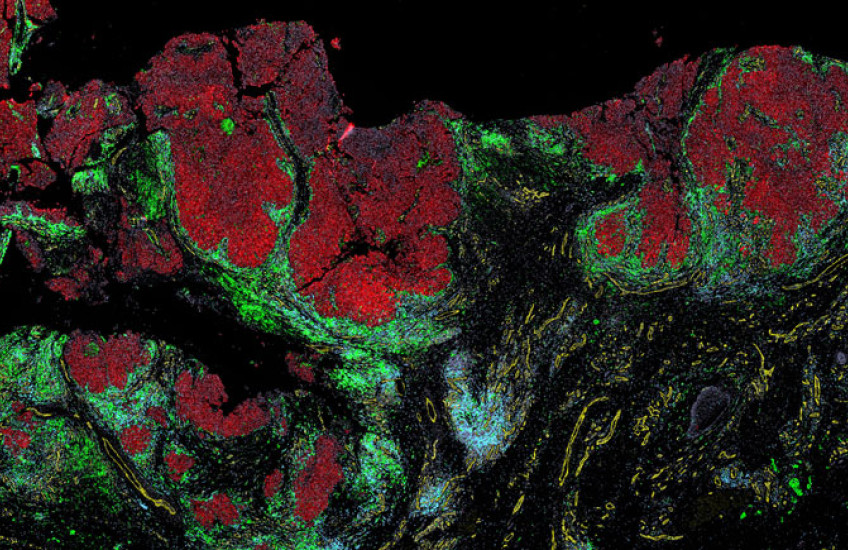 Patches of red melanoma cells surrounded by layers of blue and green immune cells. 