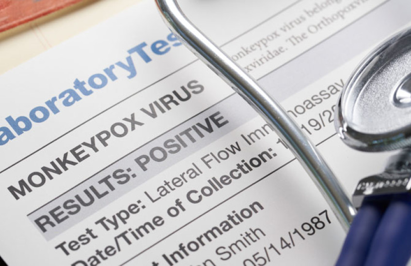 Shot of a positive monkeypox lab test report with a stethoscope