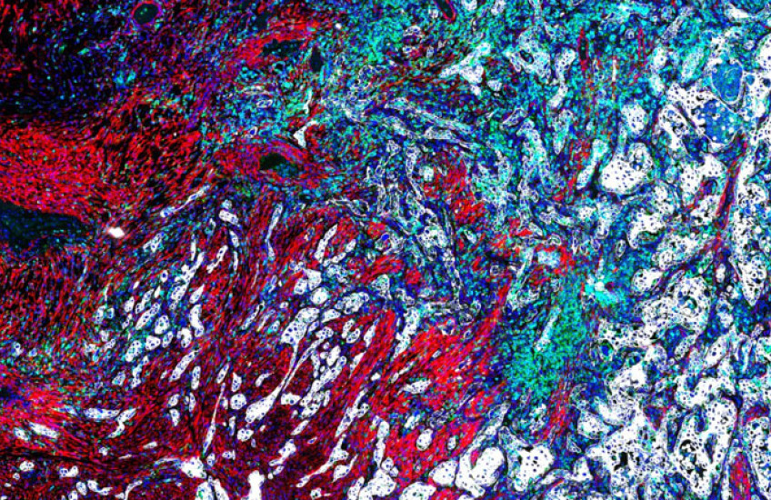 A close up image of a lung cancer tumor, composed of patches of red, white, blue, and green cells