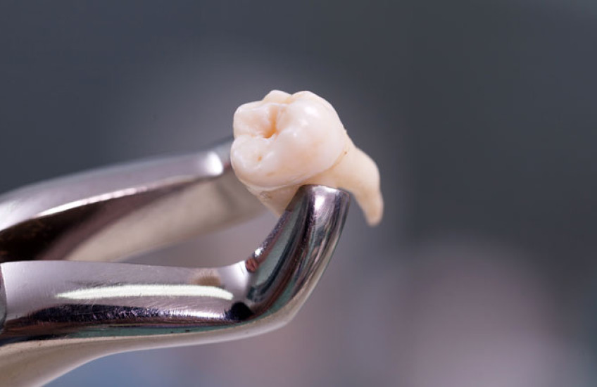 Photo of an extracted tooth