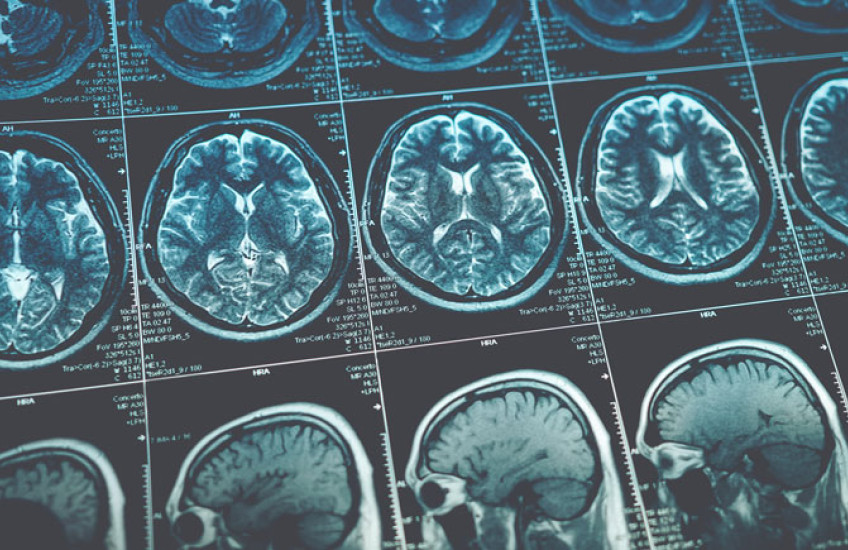 Rows of blue and white brain scans on a black background