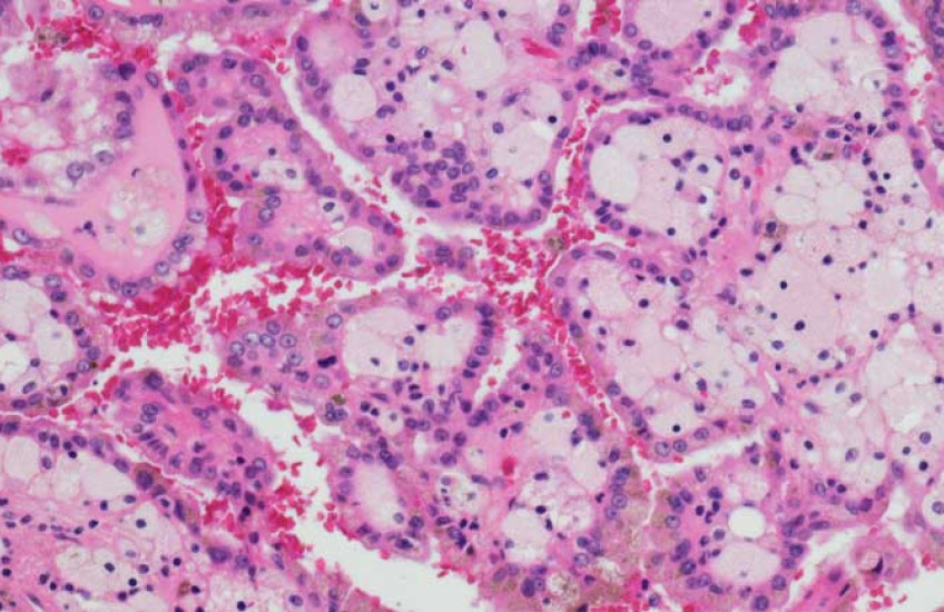 renal cancer cells