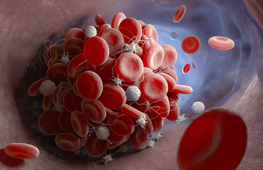 blood clot