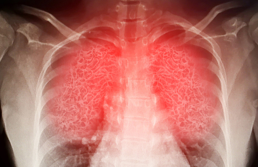 lung