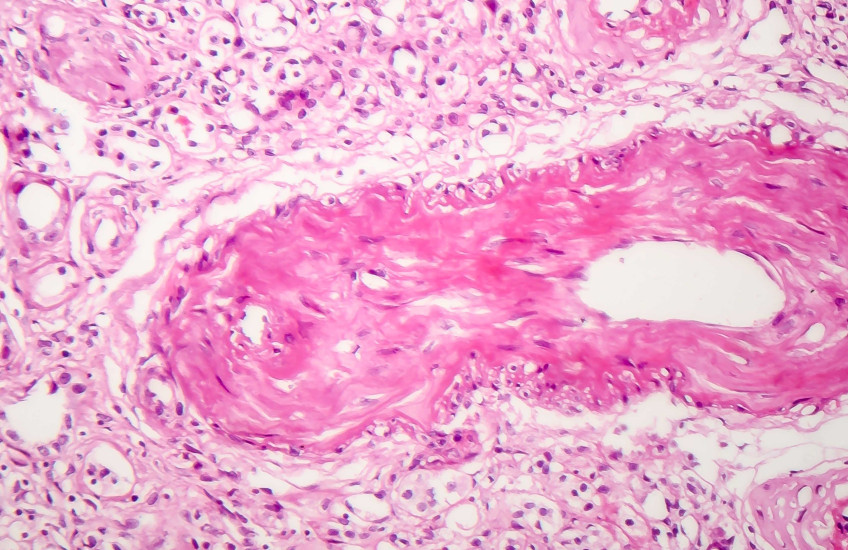 Contracted kidney, light micrograph 