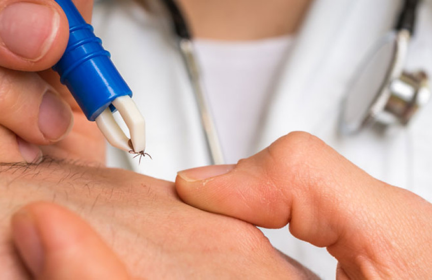 Physician extracting a tick with tweezers 