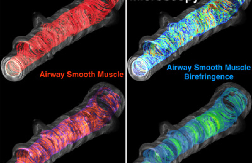 Two kinds of imaging—optical coherence tomorgraphy and mechano-microscopy—reveal airway volume and thickness during an asthma attack (left) and an estimation of the force with which the airway muscle contracts. Image: Mass General