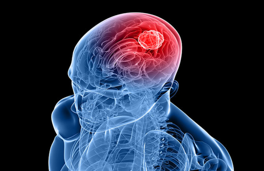 brain tumor