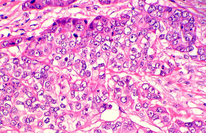 breast cancer cells